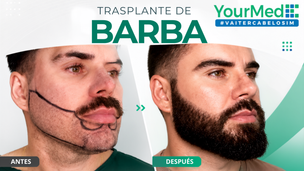 Injerto de barba en Las Condes: diseño, densidad y evaluación en YourMed